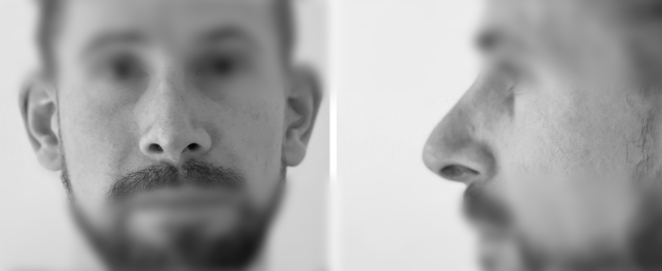 Dr Pellet Diptique rhinoplatie apres