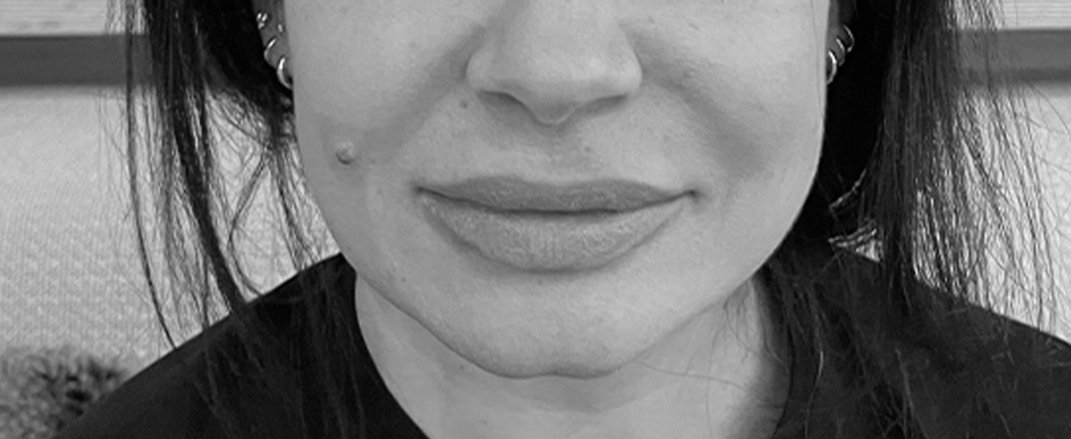 Dr Pellet acide hyaluronique levres apres