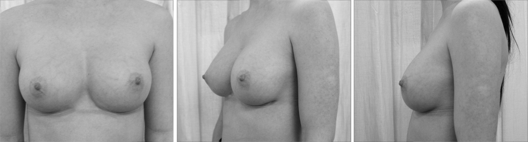 Dr Pellet augmentation poitrine classique après