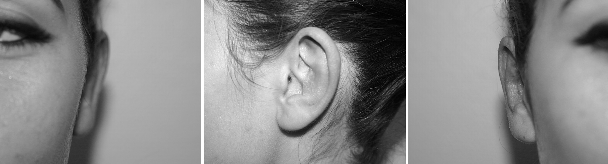 Dr Pellet chirurgie otoplastie apres