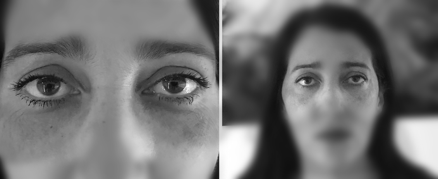 Dr Pellet chirurgie visage yeux blepharo apres