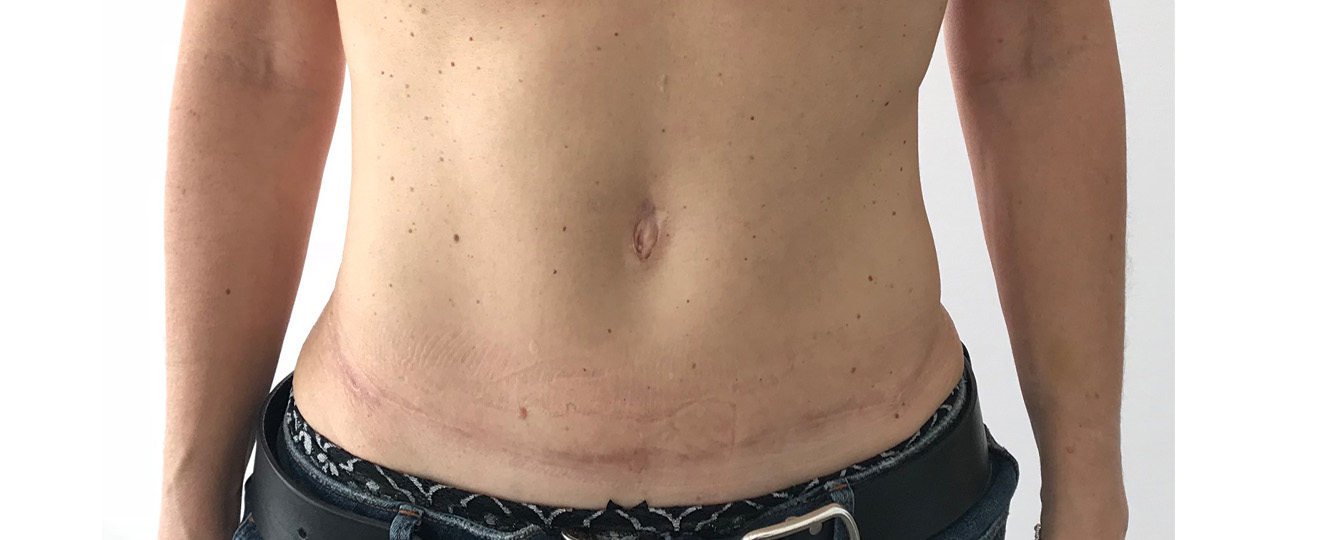 Pellet abdominoplastie avant apres 0000 DrPellet abdominoplastie 1.1